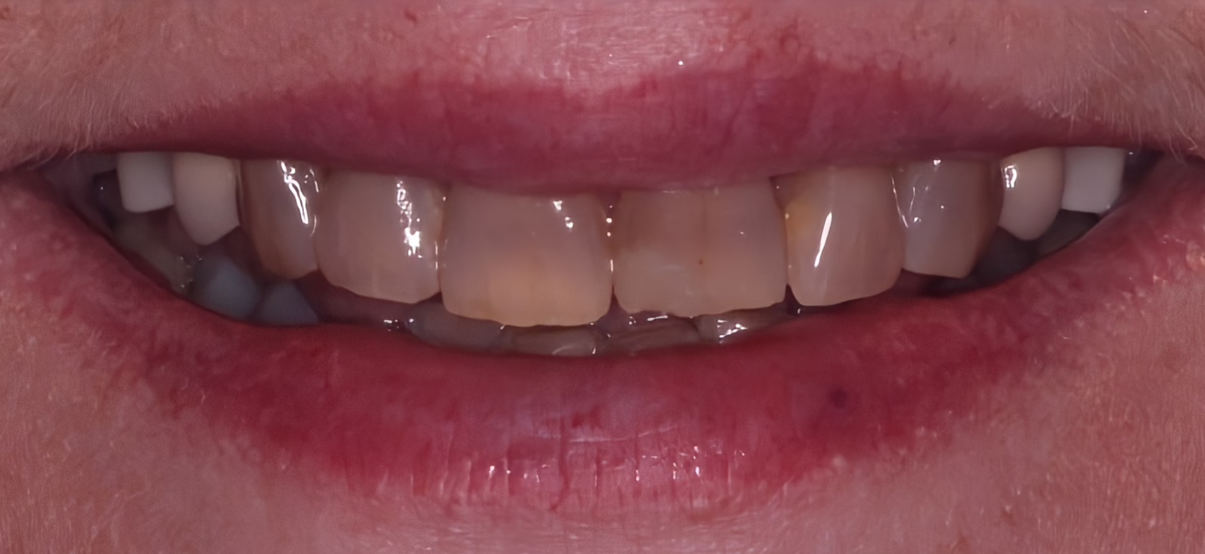 before